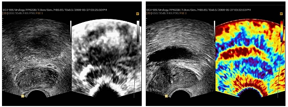 Vorteile des Elastoscan Verfahren